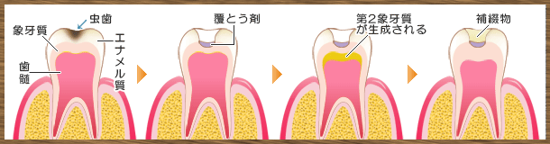 歯髄覆とう処置